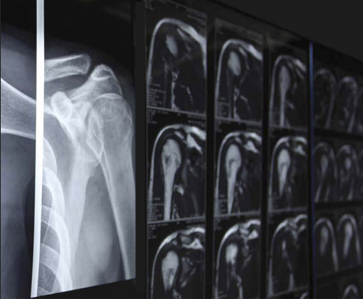 rayos x de artrosis