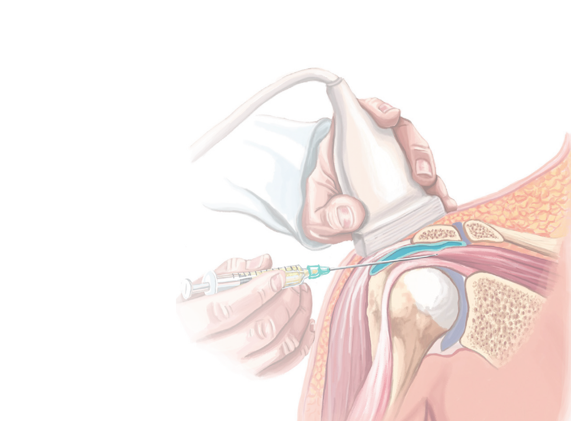 Plasma rich in growth factors versus corticosteroid injections for management of chronic rotator cuff tendinopathy: a prospective double-blind randomized controlled trial with 1 year of follow-up