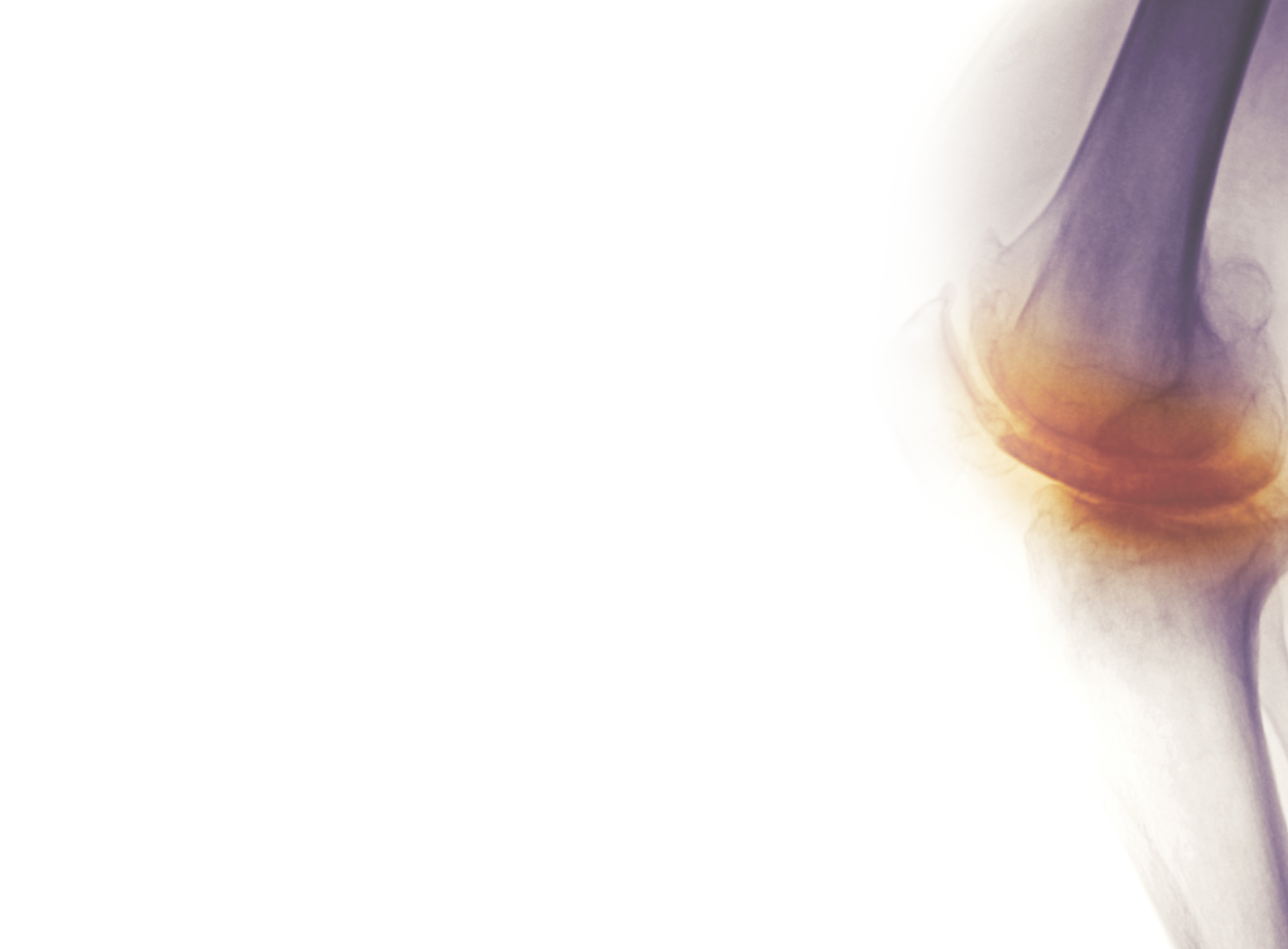 Office-Based Intraosseous Infiltrations of PRGF as an Effective Treatment for Knee Osteoarthritis: A Retrospective Observational Clinical Study