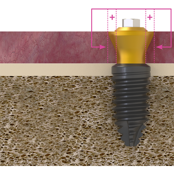 detalle de implantes core system bti