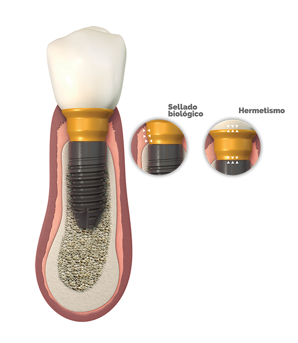 detalle de protesis dental bioblock bti