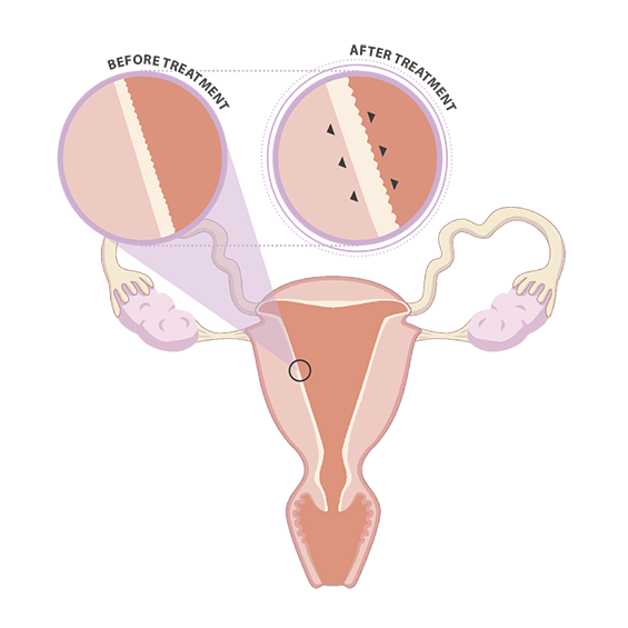 aparato reproductor femenino con endoret prgf