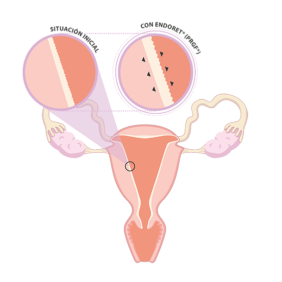 aparato reproductor femenino con endoret prgf